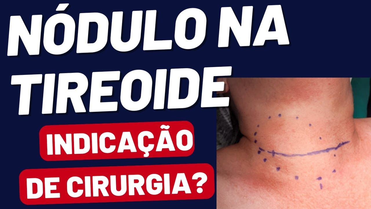 Nódulo na tireoide - quando tem que operar? Câncer, Bócio, Hipertireoidismo