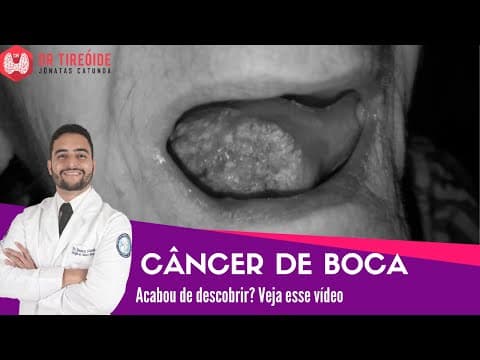 Câncer de boca - Vídeo para quem acabou de descobrir! | Dr Jônatas Catunda