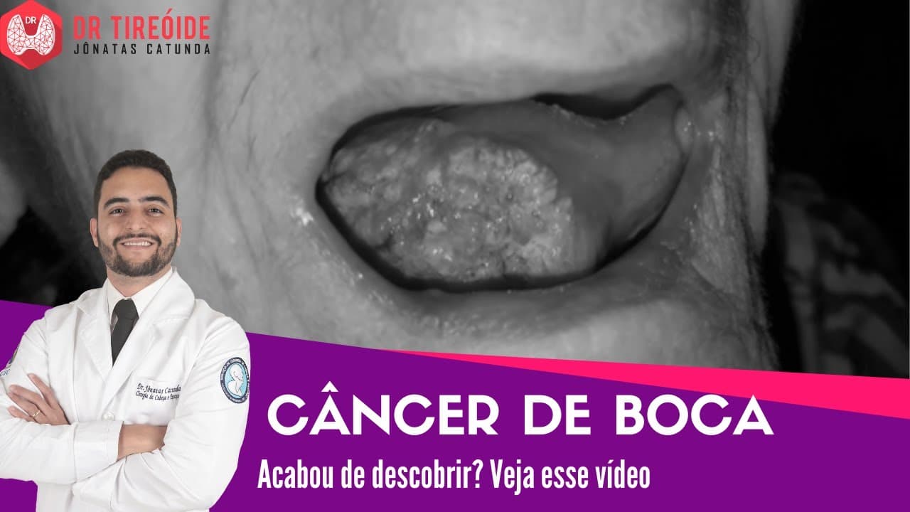 Câncer de boca - Vídeo para quem acabou de descobrir! | Dr Jônatas Catunda