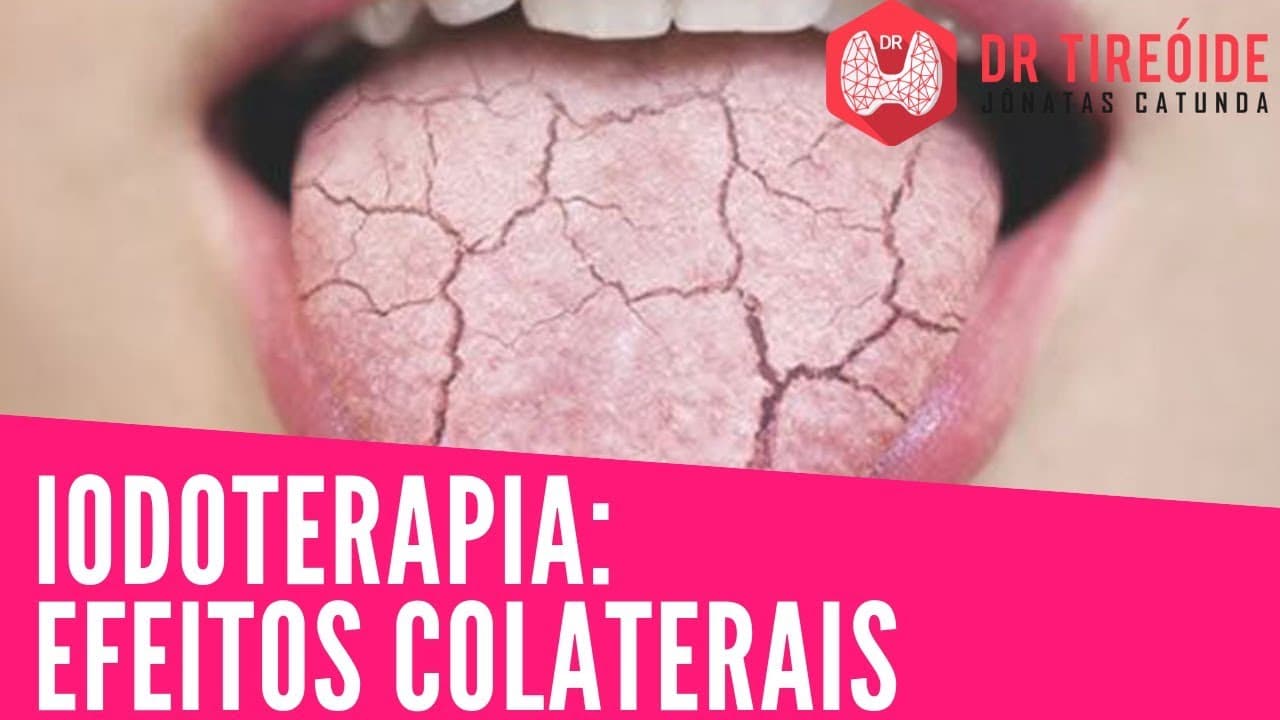Efeitos colaterais da iodoterapia: o que é real