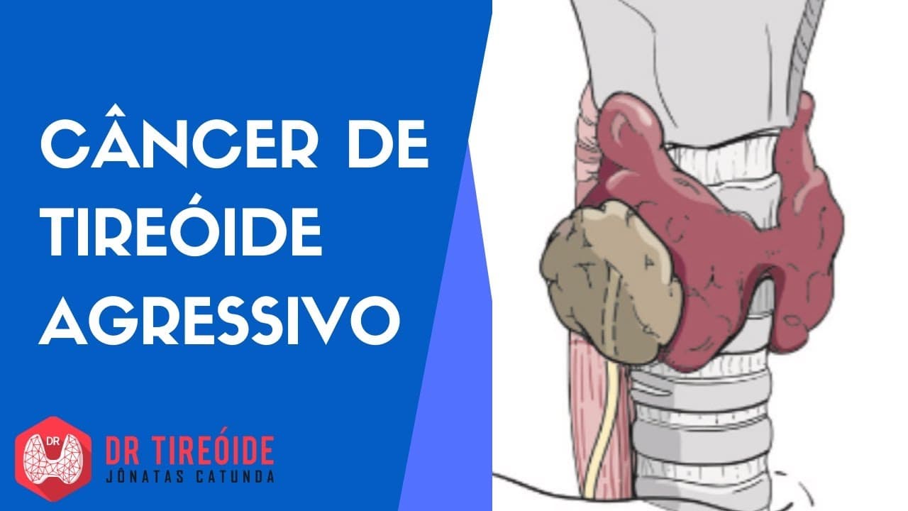 Câncer de tireóide agressivo - Dr Tireóide responde