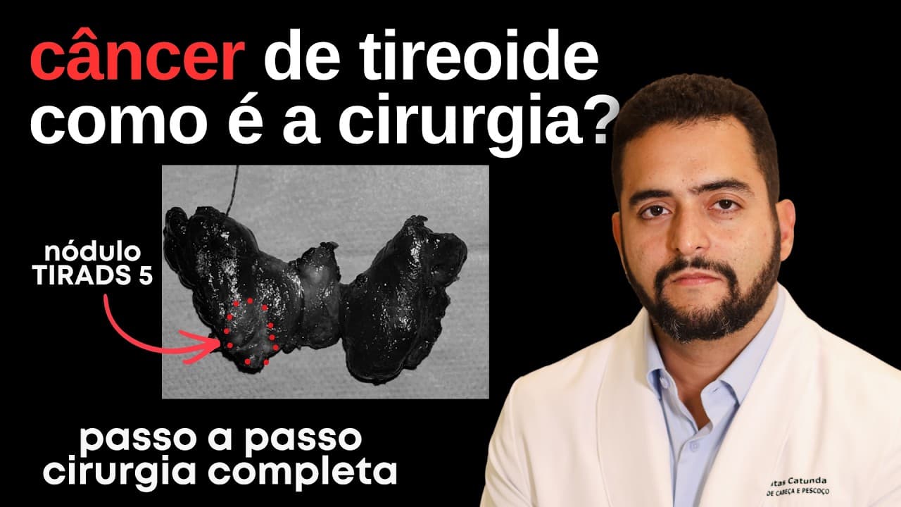 Câncer de tireoide: como é a cirurgia? - Cirurgia completa filmada passo a passo