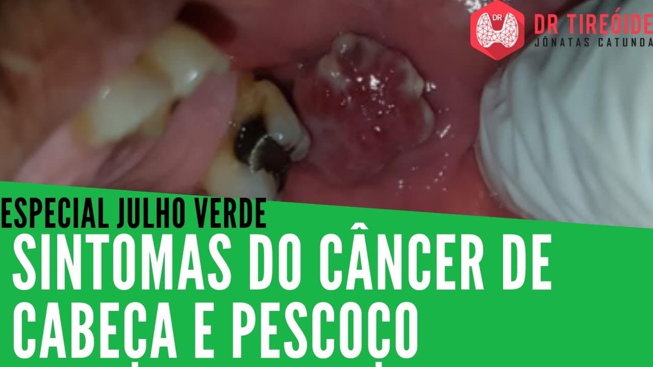 Julho Verde - Sintomas do Câncer de Cabeça e Pescoço