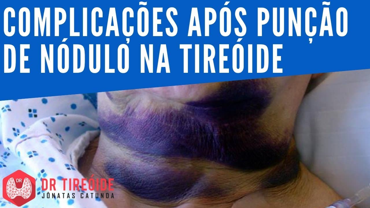 Complicações após punção de nódulo na tireóide | Dr Tireóide Responde