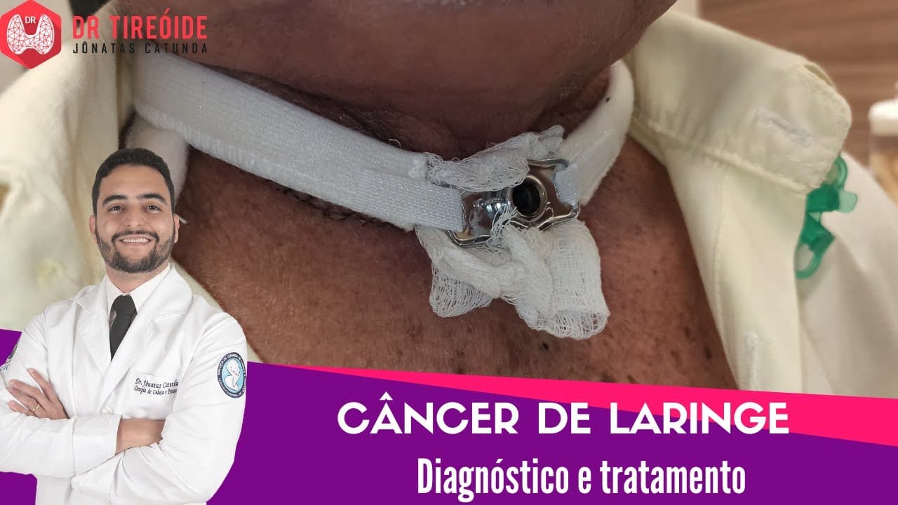 Câncer de laringe - Aula para a Disciplina de Cirurgia de cabeça e pescoço UFC