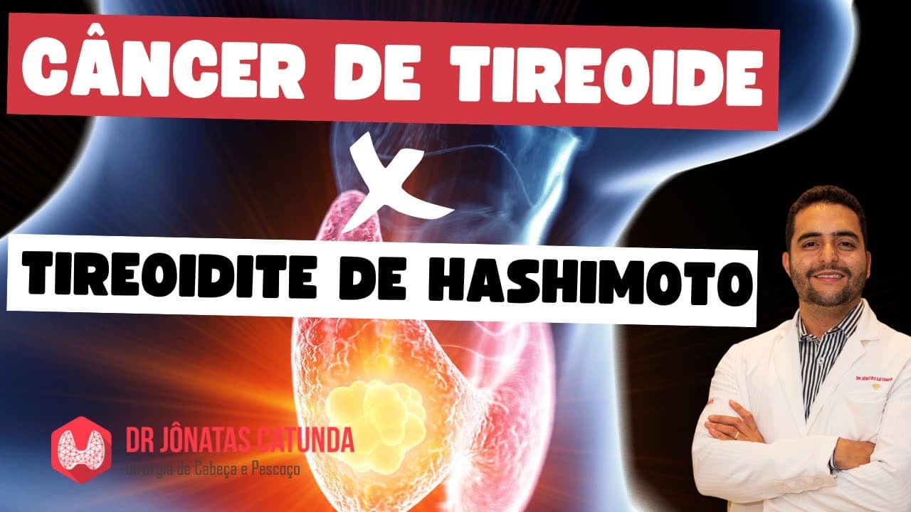 Artigo encontra relação entre Tireoidite de Hashimoto e Câncer de tireóide