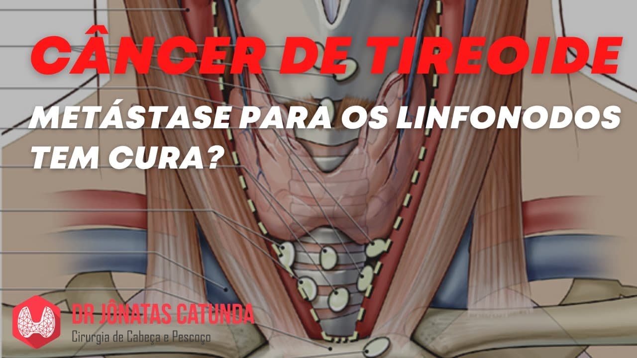 Metástase para o linfonodo tem cura? | Câncer de tireoide