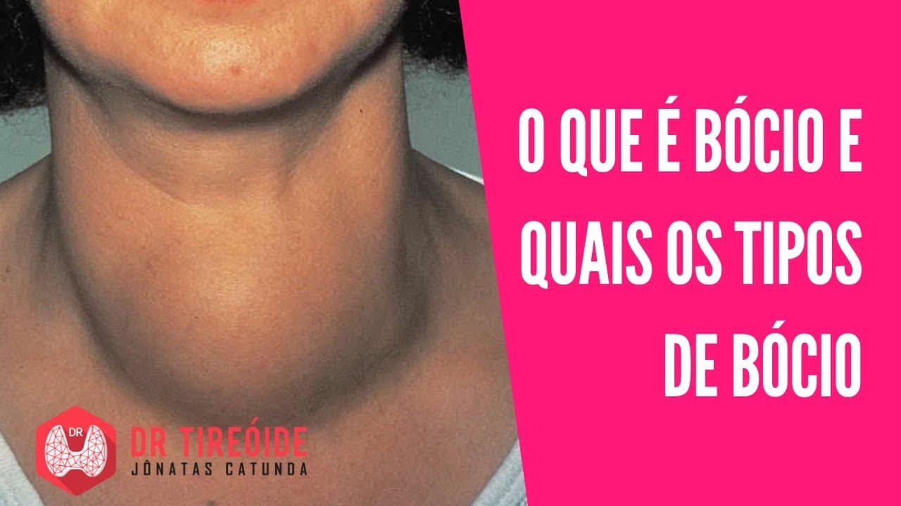 Bócio - O que é, Tipos de Bócio (multinodular, difuso) | Dr Jônatas Catunda