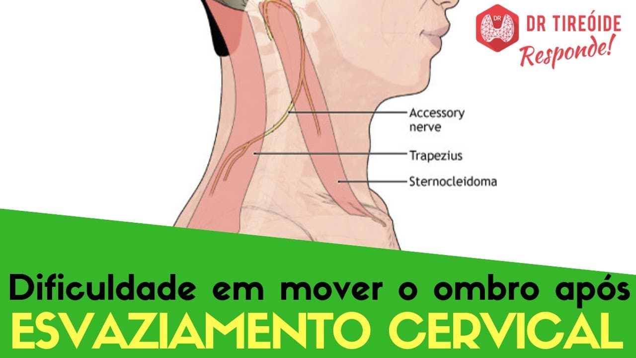 Dificuldade em mover o ombro após esvaziamento cervical - Dr Tireóide Responde