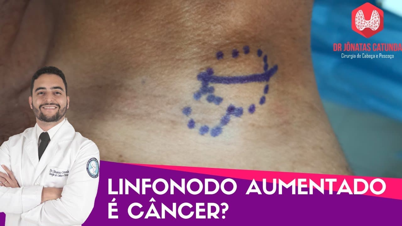 Linfonodo aumentado é câncer? Dr Jônatas Catunda