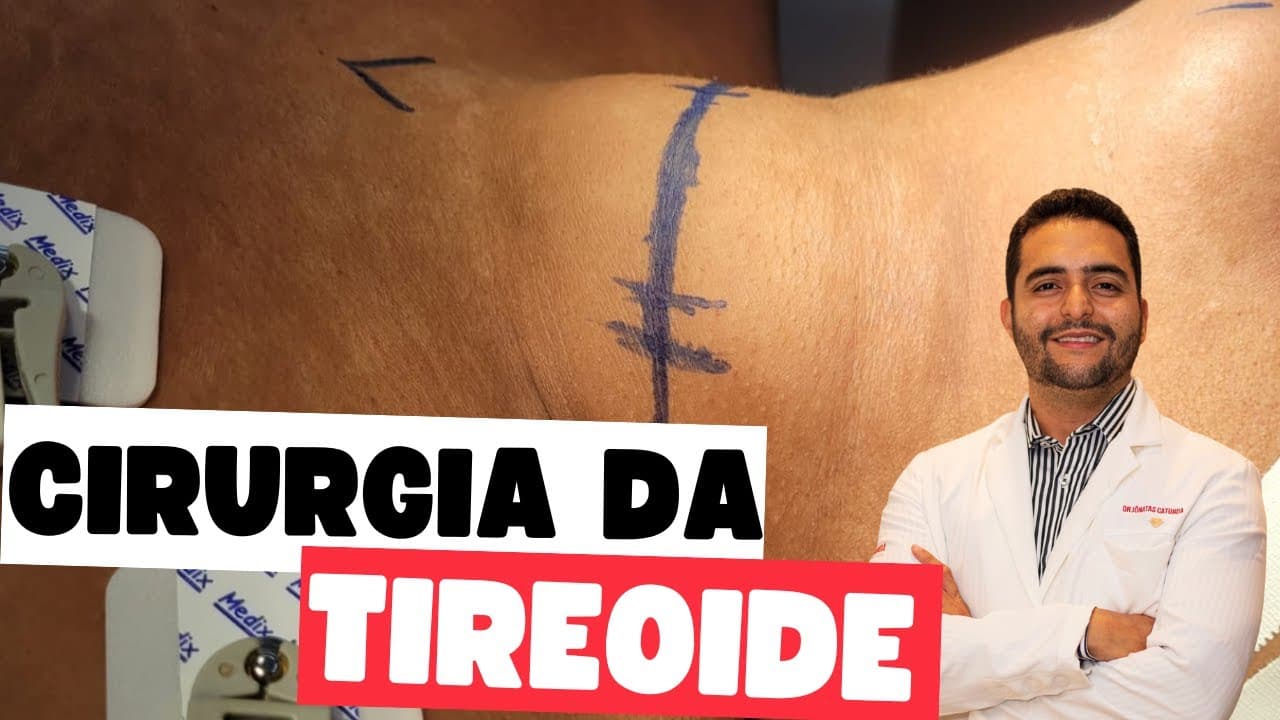 Tireoidectomia total - Riscos, complicações / Hiperparatireoidismo secundário