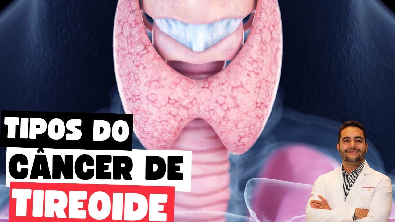 Conheça os tipos de câncer de tireoide: saiba mais sobre sintomas e tratamentos