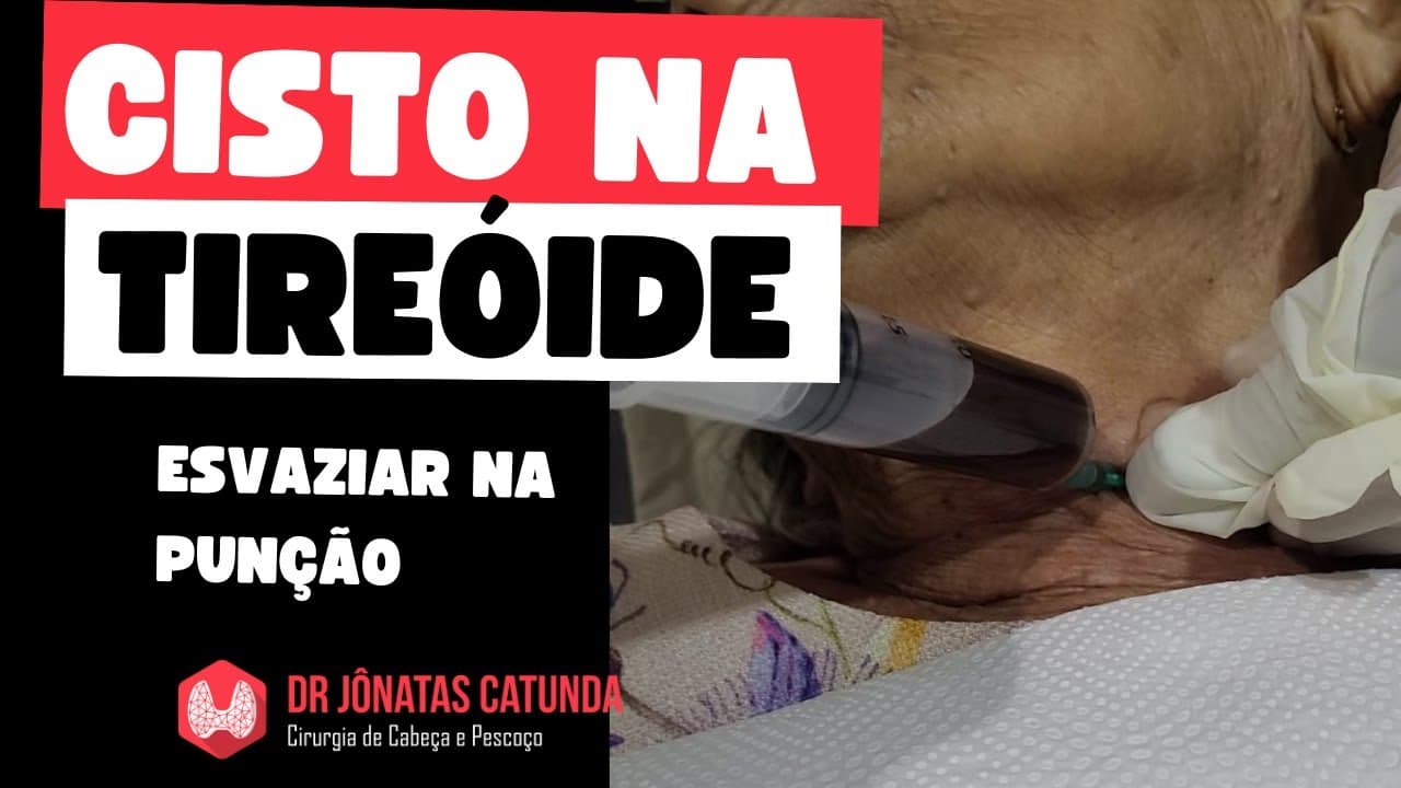 Tratamento do cisto na tireoide volumoso