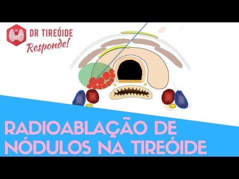 Radioablação de nódulos na tireóide - Dr Tireóide Responde
