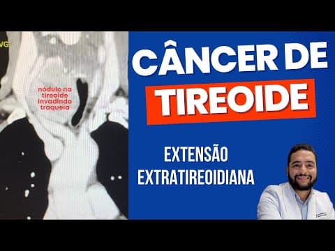 Extensão extratireoidiana do câncer de tireoide