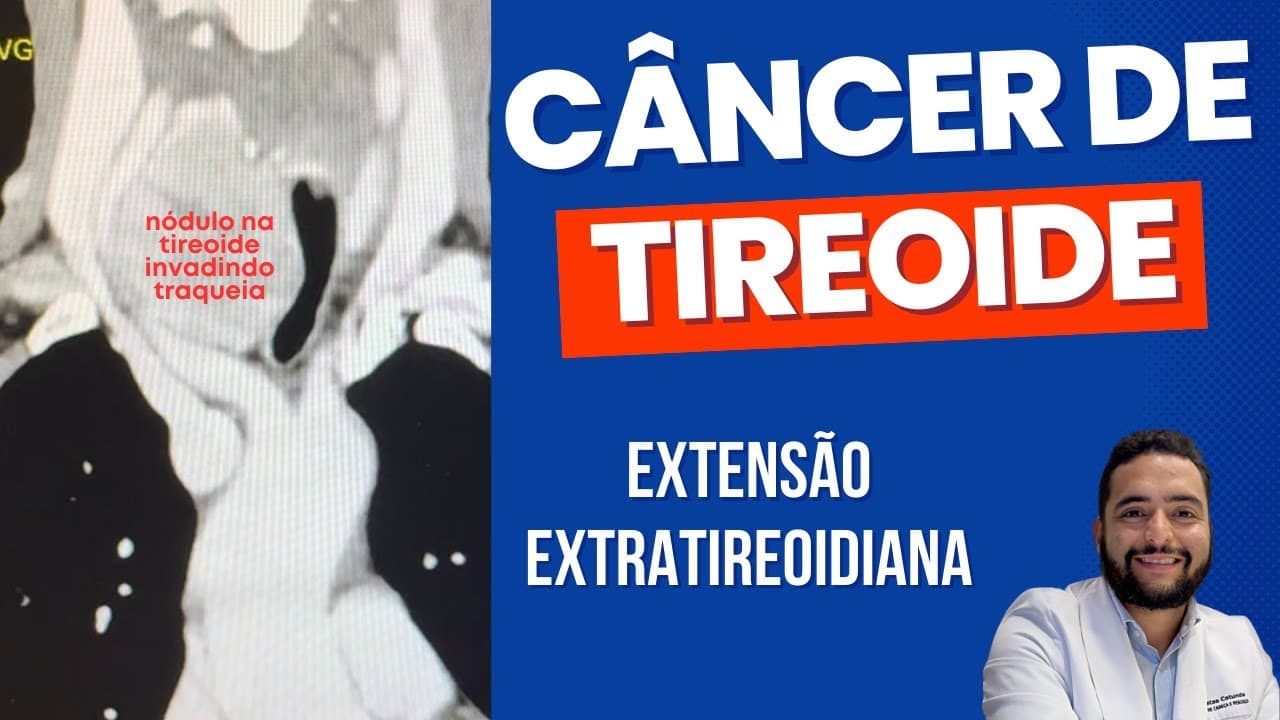 Extensão extratireoidiana do câncer de tireoide