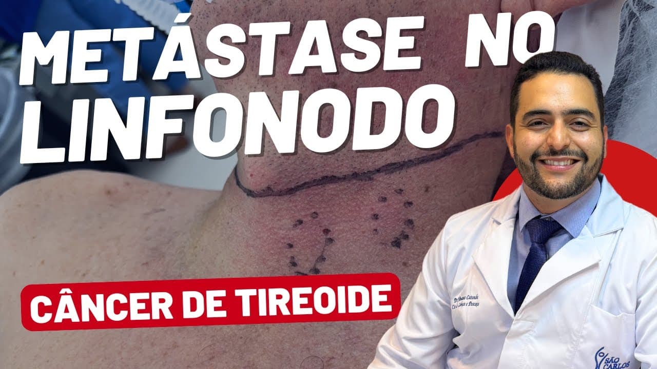 Metástase para o linfonodo no Câncer de tireoide