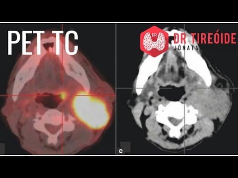 PET ou PET-TC - Entenda como é esse exame e porque ele é tão importante!
