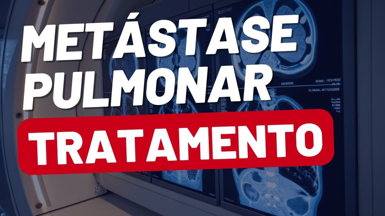 Como funciona a iodoterapia nas metástases de tireoide
