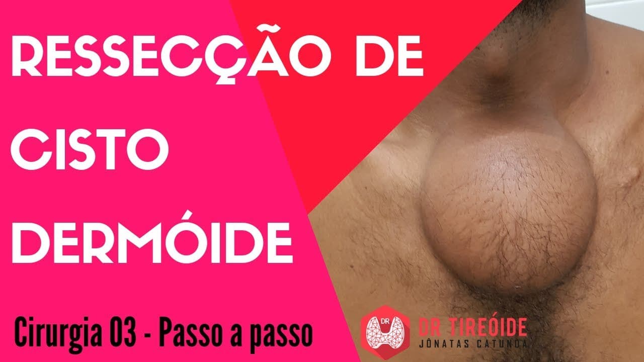 Cisto Dermóide Volumoso - Cirurgia Passo a passo | Dr Jônatas Catunda