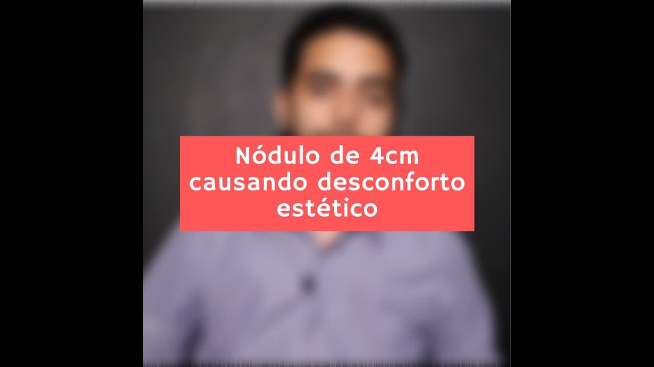 Nódulo na tireóide de 4cm causando desconforto estético