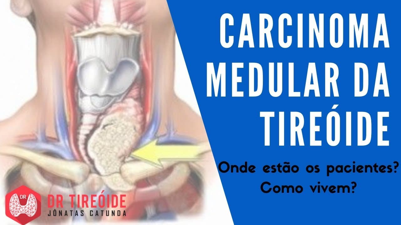 Carcinoma Medular da tireóide - Dr Tireóide Responde