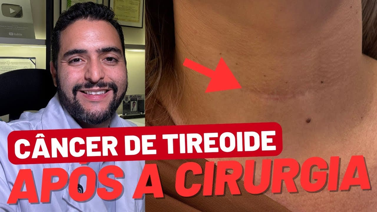 As etapas do tratamento do câncer de tireoide