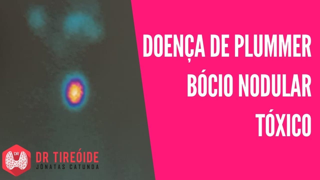 Doença de Plummer, o bócio nódulo tóxico, causa de hipertireoidismo | Dr Jônatas Catunda