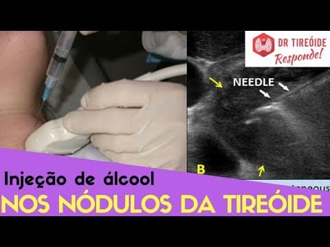 Ablação de nódulos na tireóide com álcool - Dr Tireóide Responde