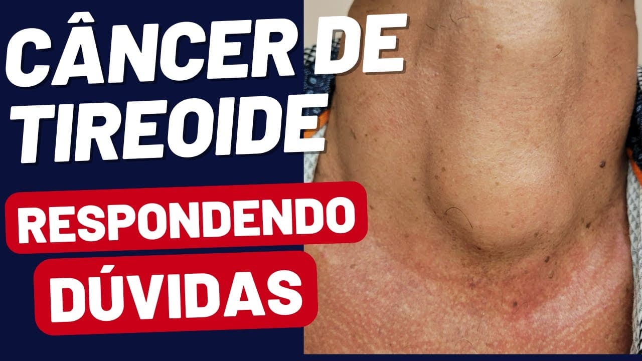 Câncer de Tireoide: Esclarecendo as Dúvidas Mais Comuns