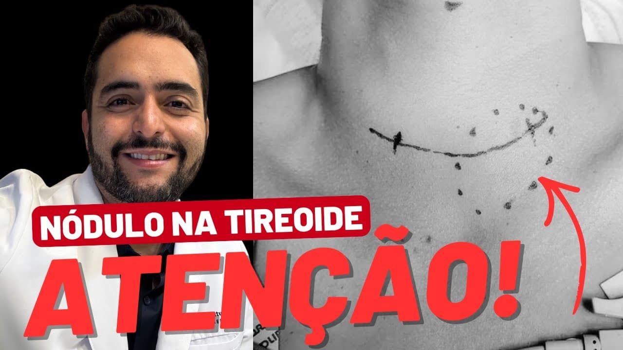 Quando um nódulo na tireoide merece mais atenção?