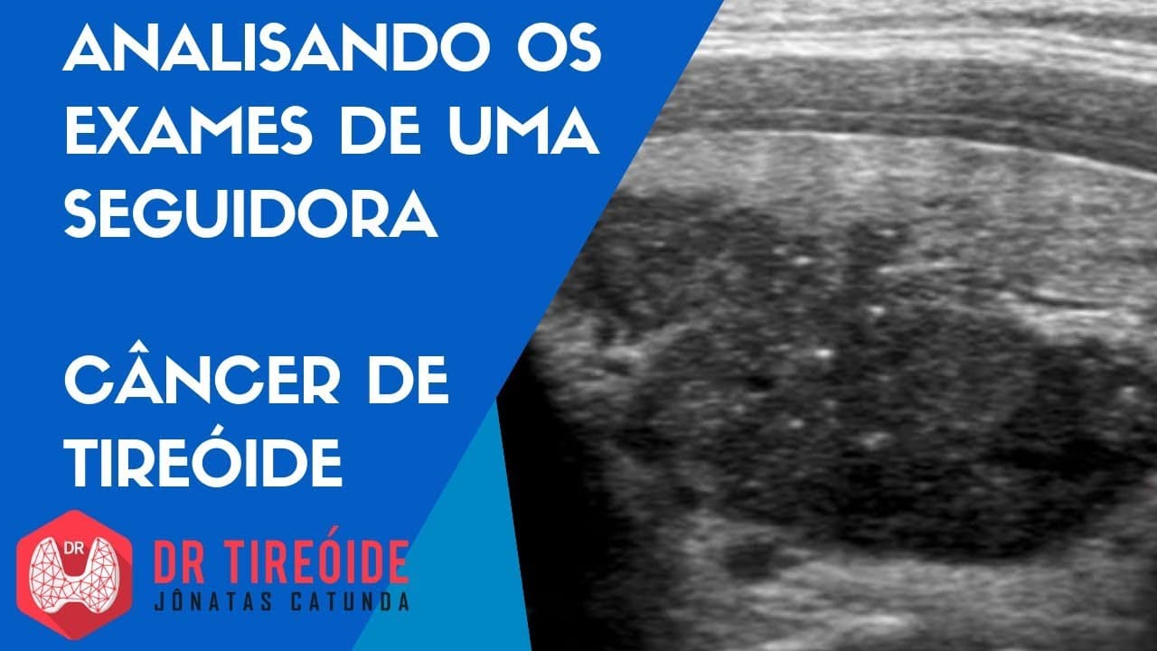 Analisando os exames de uma seguidora sobre câncer de tireóide | Dr Tireóide Responde