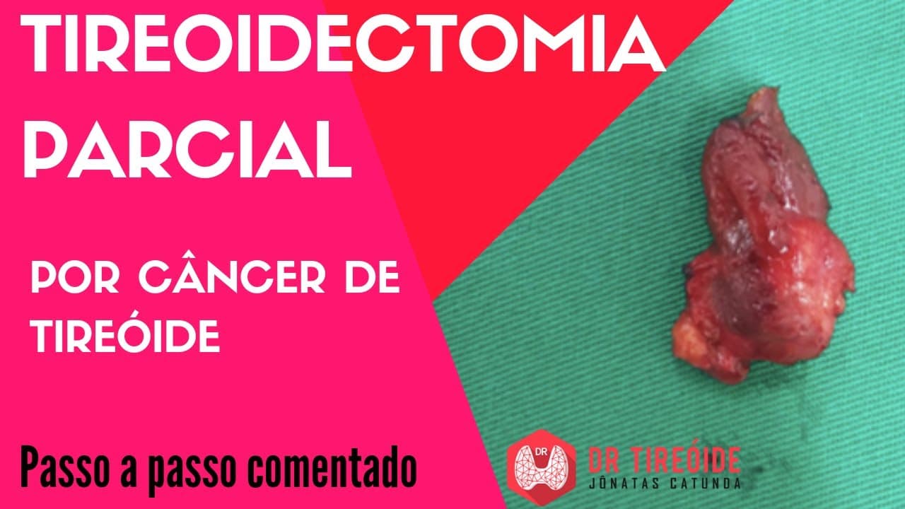 Tireoidectomia parcial por câncer de tireóide - Cirurgia Passo a passo | Dr Jônatas Catunda