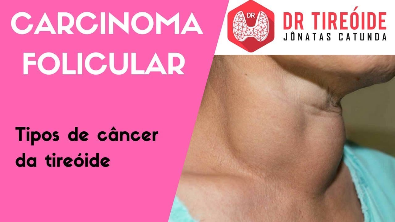Carcinoma Folicular - Tipos de câncer de tireóide | Dr Jônatas Catunda
