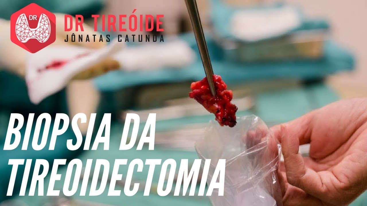 Resultado da biópsia da tireoidectomia - Como interpretar? | Dr Jônatas Catunda