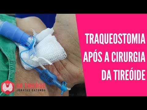 Risco de traqueostomia logo após a cirurgia da tireóide | Dr Jônatas Catunda