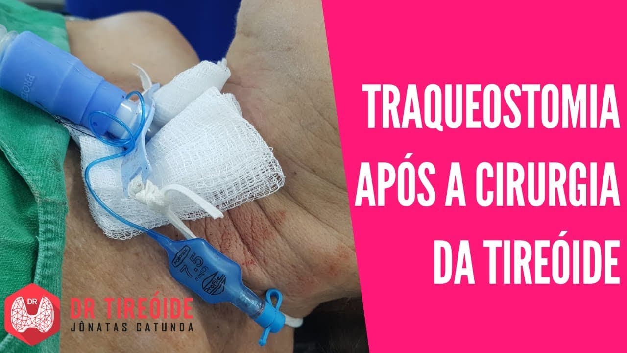 Risco de traqueostomia logo após a cirurgia da tireóide | Dr Jônatas Catunda
