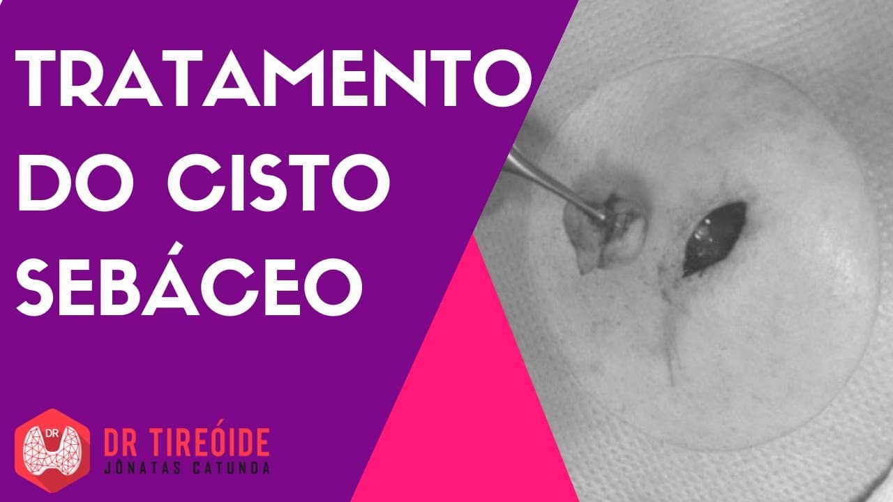 Tratamento do cisto sebáceo - Dr Jônatas Catunda