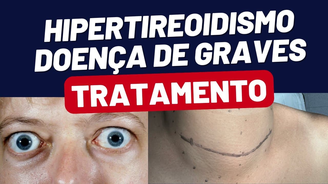 TRATAMENTO DA DOENCA DE GRAVES HIPERTIREOIDISMO