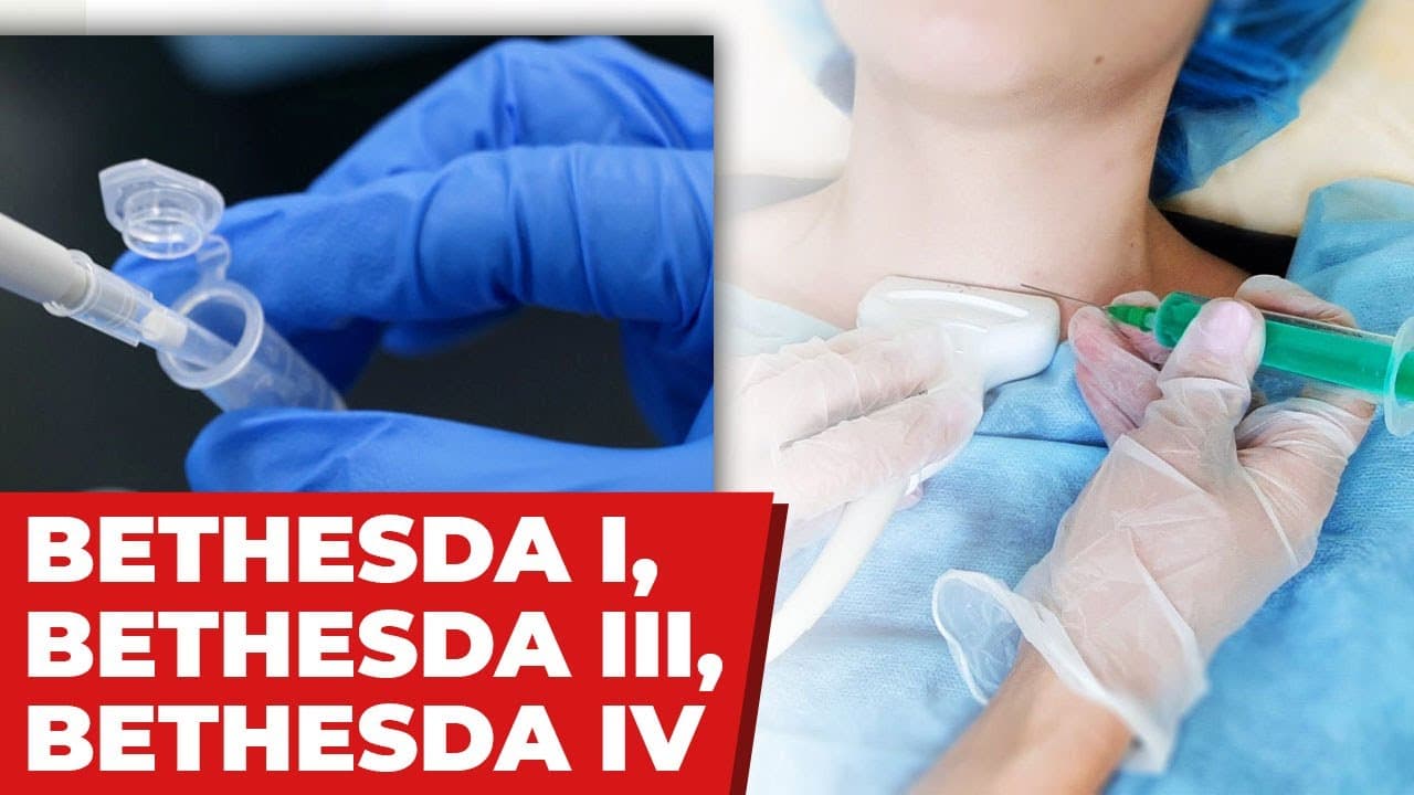 Resultado Bethesda I, III ou IV da punção da tireoide - Indeterminado. E agora?