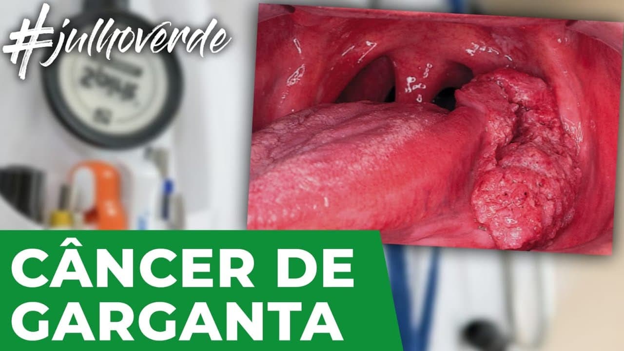 Câncer de orofaringe | Campanha Julho Verde
