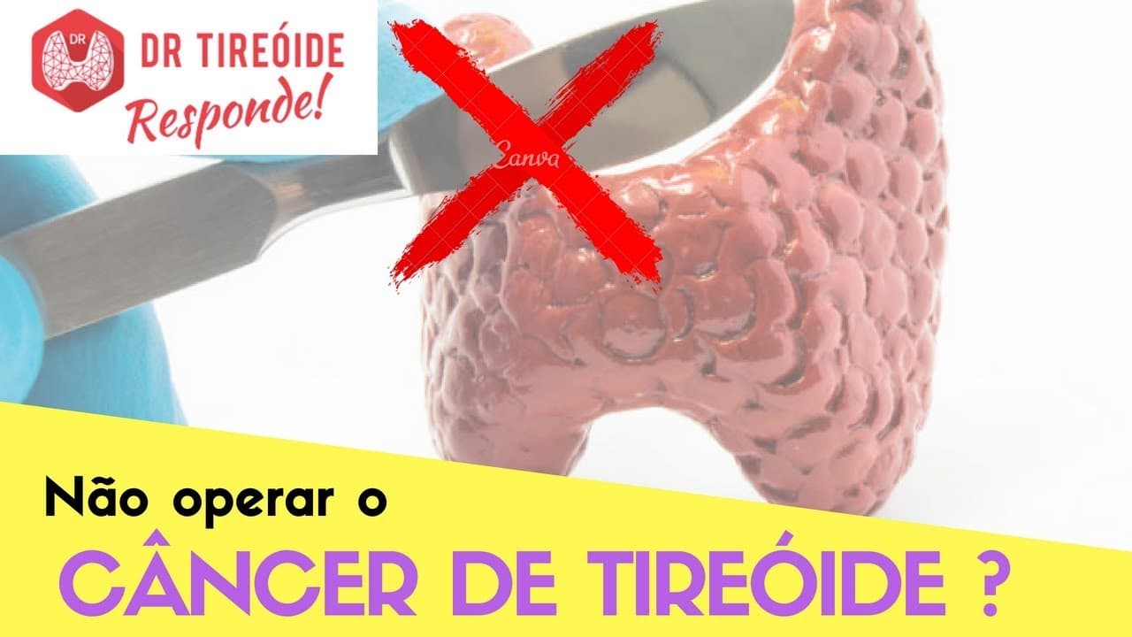 Não operar o câncer de tireóide? - Dr Tireóide Responde