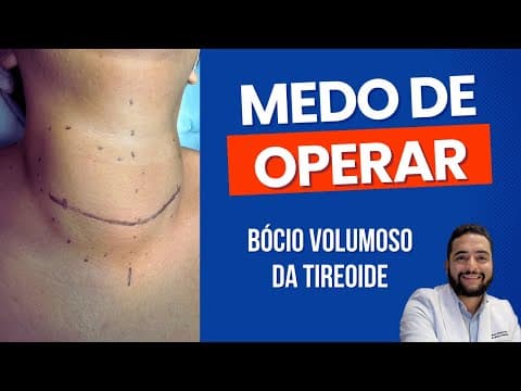 Tireoidectomia - Medo de operar o bócio volumoso