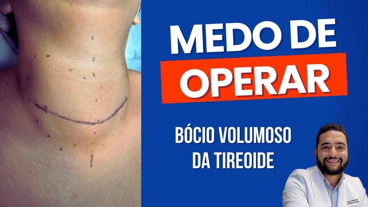 Tireoidectomia - Medo de operar o bócio volumoso