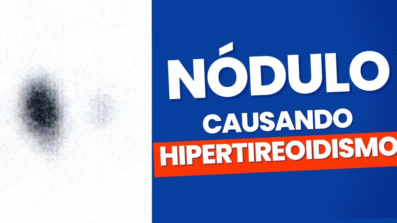 Doença de Plummer: Nódulo causando hipertireoidismo