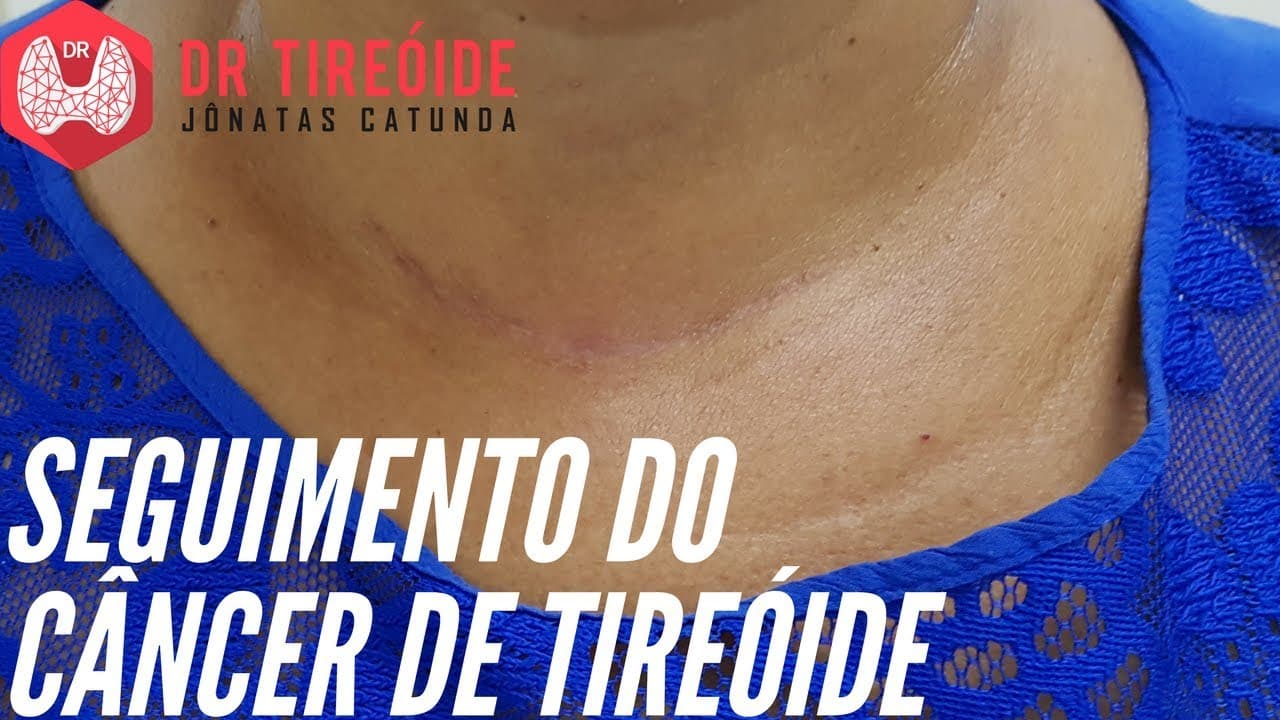Acompanhamento do câncer de tireóide - Tireoglobulina? Anti-tireoglobulina? Ultrassom?
