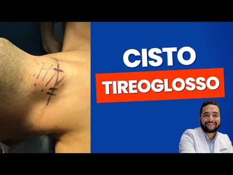 Cisto tireoglosso - o que é? Sintomas? Exames? Tratamento?