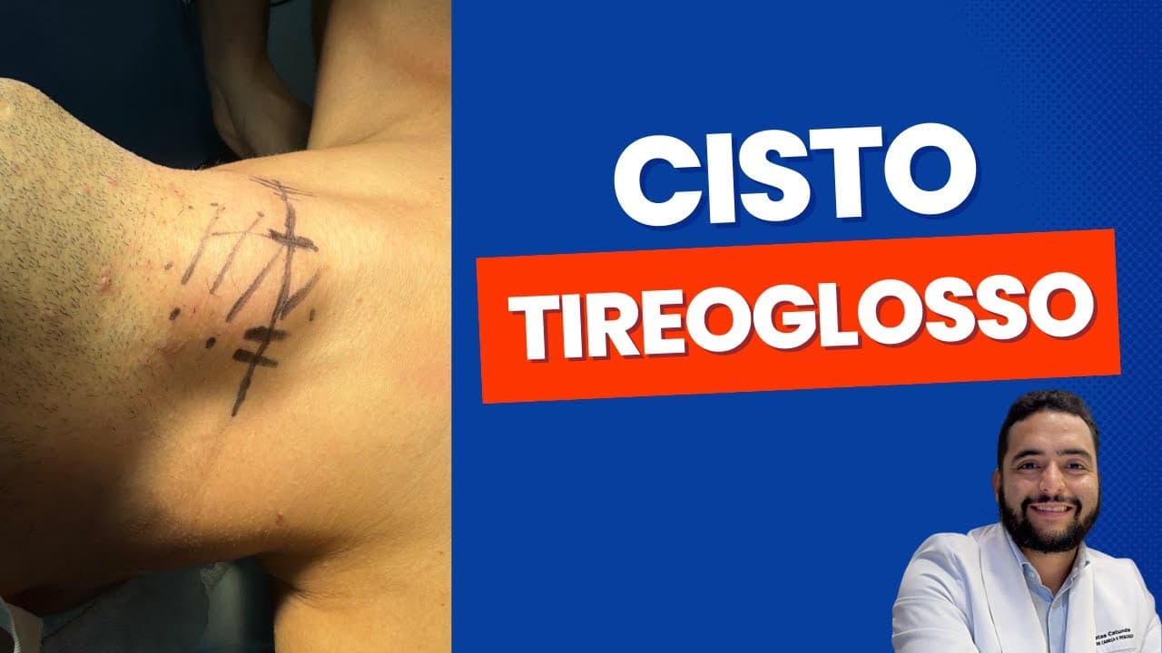 Cisto tireoglosso - o que é? Sintomas? Exames? Tratamento?