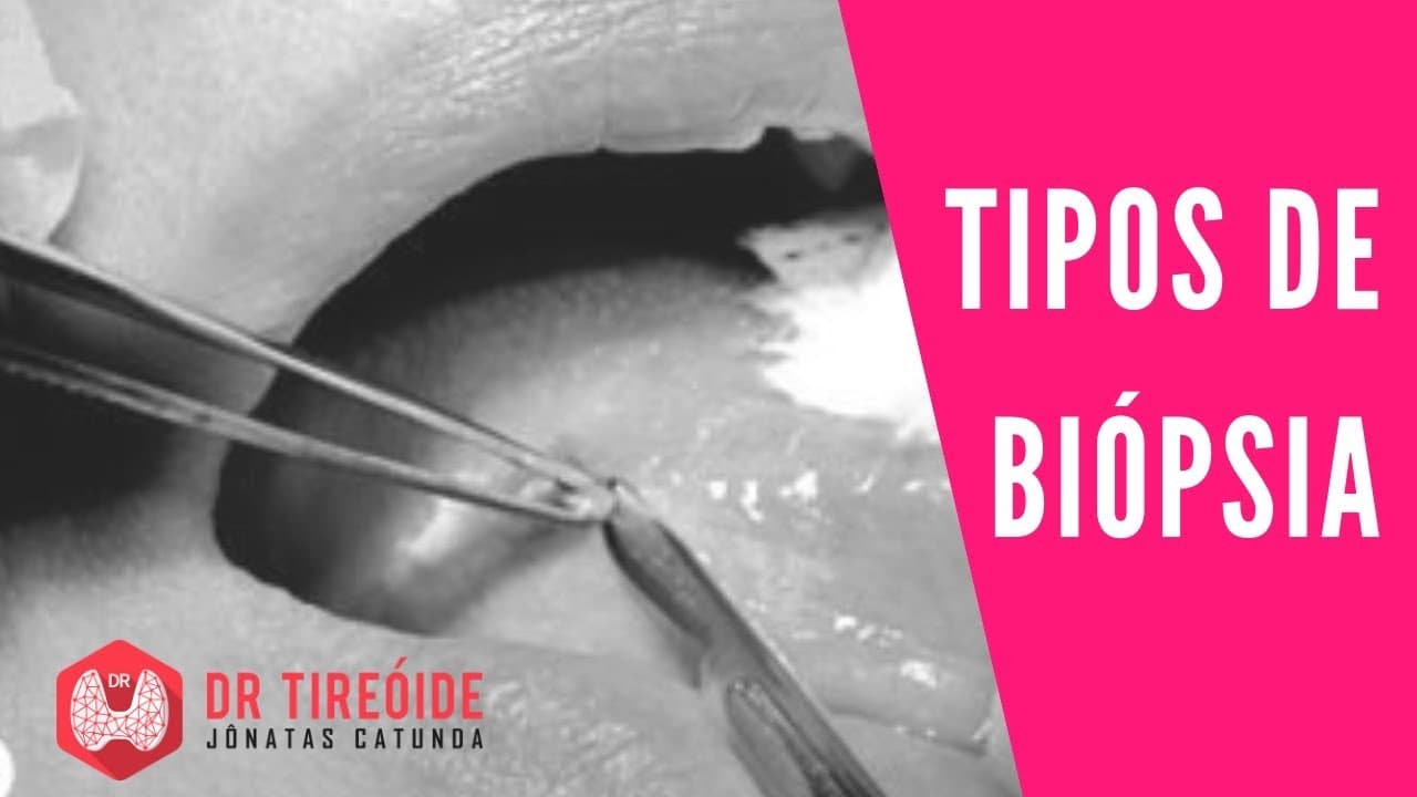 Tipos de biópsia - Incisional, excisional, PAAF, CORE... | Dr Jônatas Catunda