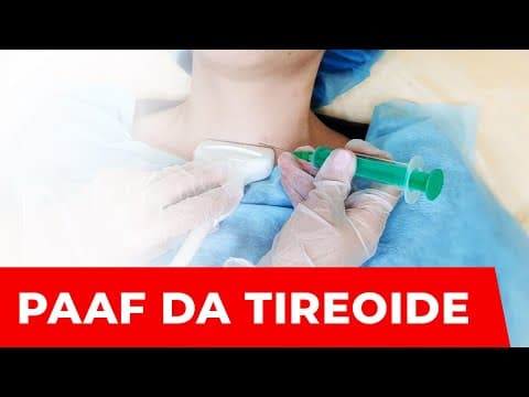 Resultado da PAAF - Punção da tireoide e classificação de Bethesda